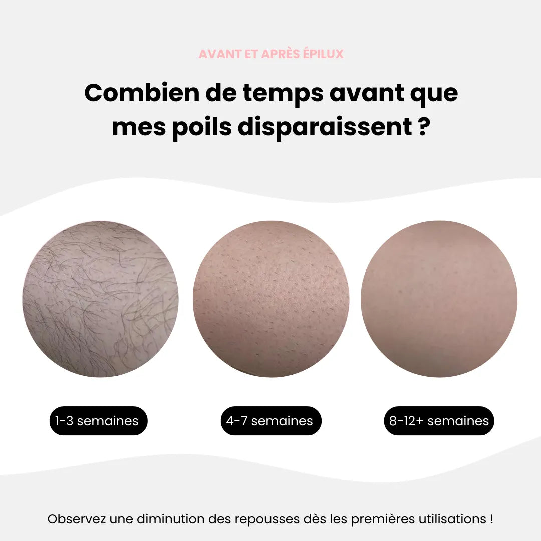 ÉpilLux© | Épilation Définitive à la Lumière Pulsée IPL